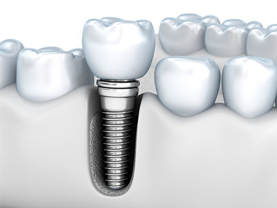 dental implant