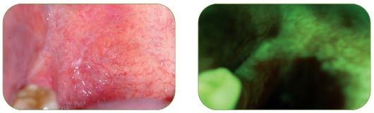 cancerous lesion